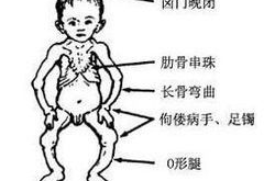 佝偻病的早期症状,关注儿童健康成长的信号